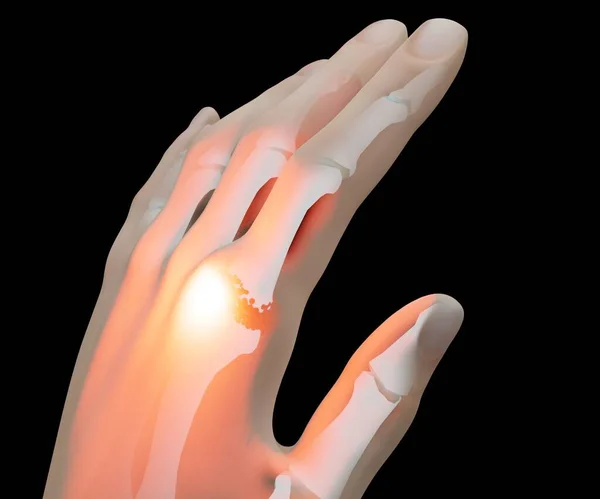 Illustration of Gout arthritis, Joint pain. finger pain. Human bone anatomy 3d rendered