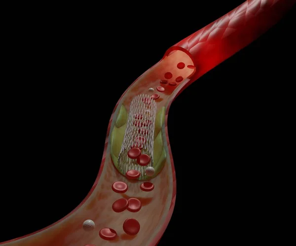 Stent Kan Damarına Yerleştirilmiş Bir Tüpüdür Kan Akışını Hızlandırmak Için — Stok fotoğraf