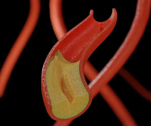 Атеросклероз Утолщение Затвердевание Артерий Вызванное Скоплением Бляшек Внутренней Подкладке Трехмерной — стоковое фото