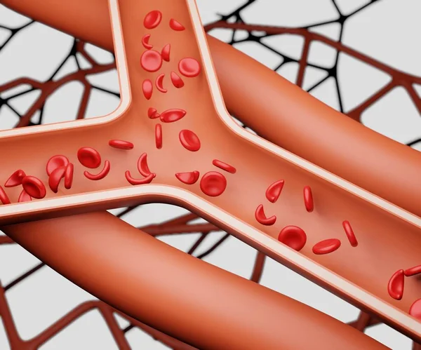 赤血球は毛細血管にクレセントまたは鎌状赤血球を持っています これらの鎌状赤血球も剛性と粘着性の3Dレンダリングになります — ストック写真
