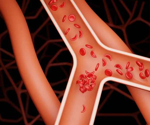 赤血球の病気は 深部静脈血栓症3Dレンダリングと呼ばれる深部静脈に血栓を開発するリスクを高めることができます — ストック写真