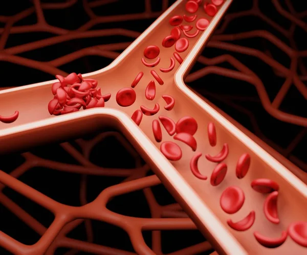 赤血球の病気は 深部静脈血栓症3Dレンダリングと呼ばれる深部静脈に血栓を開発するリスクを高めることができます — ストック写真
