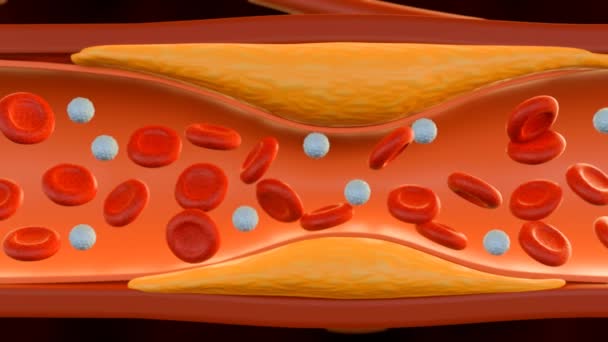 Animación Sangre Que Fluye Través Formación Placa Colesterol Arteria Aterosclerosis — Vídeos de Stock