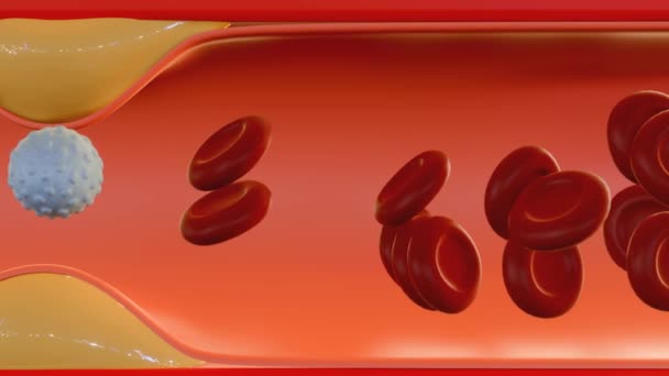 Анімація Формування Зубного Нальоту Холестерину Артеріях Атеросклерозі Гемаглютинованій Крові — стокове відео