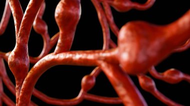 Mikro anevrizmaların (MA 'lar) 3D rendelenmesi, bunlar retinadaki kan damarlarının küçük şişmeleridir.