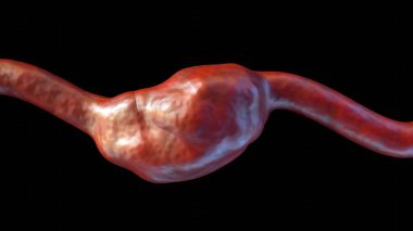 3d rendering of fusiform-shaped aneurysm bulges or balloons out on all sides of the blood vessel clipart