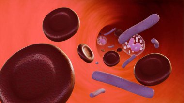 3d rendering of Septicemia, or sepsis, is the clinical name for blood poisoning by Klebsiella spp. bacteria. clipart