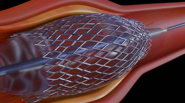 Kan kılcal damarındaki üç boyutlu bir stent işlemi görselleştirebilir. Anjiyoplasti, kalbe kan sağlayan daraltılmış veya tıkanmış kan damarlarını açmak için yapılan bir işlemdir..