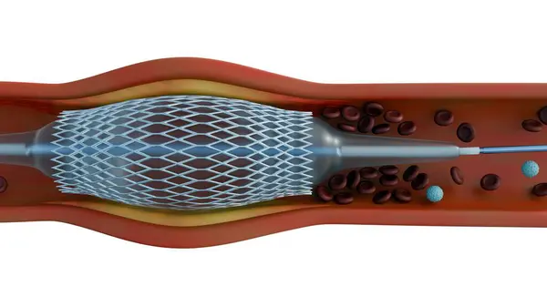 stock image A 3D rendering of a stent inside a blood capillary can visualize the procedure. Angioplasty is a procedure to open narrowed or blocked blood vessels that supply blood to the heart.