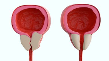 Sol alttaki erkek idrar yolundaki iki sagital çapraz kesitin 3D görüntüsü hipertrofik prostat bezi, sağ taraftaki ise karşılaştırma için normal prostat bezi..