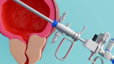3D resectoscope ve iyi huylu protez hiperplazi ya da BPH, prostat bezi büyür..