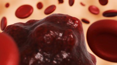 Kanserli bir oluşum içeren üç boyutlu bir kan örneği. Normal kan bileşenleri arasında bir kan tümörünün ya da kötü huylu bir hücrenin açık ve net bir şekilde temsil edilmesini sağlıyor..