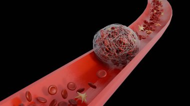 Aktif trombosit ve fibrin içeren bir kan damarındaki trombus oluşumunun 3 boyutlu görüntüsü pıhtı gelişiminde kullanılan birincil hücresel ve protein bileşenleri.