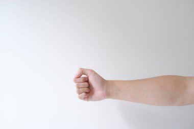 Bir sürü kırmızı lekesi olan bir adamın eli. İzole edilmiş beyaz arkaplan.