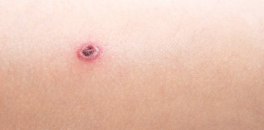 Çocuk kırmızı sivilceler ve suçiçeği ya da varisella zoster virüsü yüzünden kabarcık olmuş. Çocuklarda viral hastalık. Vücudunun her yerinde kırmızı sivilceler var. Enfeksiyon.