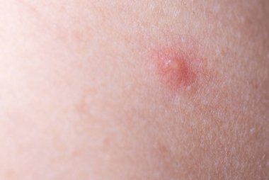 Çocuk kırmızı sivilceler ve suçiçeği ya da varisella zoster virüsü yüzünden kabarcık olmuş. Çocuklarda viral hastalık. Vücudunun her yerinde kırmızı sivilceler var. Enfeksiyon.