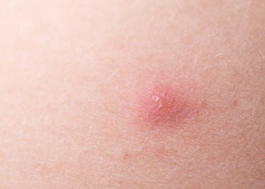 Çocuk kırmızı sivilceler ve suçiçeği ya da varisella zoster virüsü yüzünden kabarcık olmuş. Çocuklarda viral hastalık. Vücudunun her yerinde kırmızı sivilceler var. Enfeksiyon.