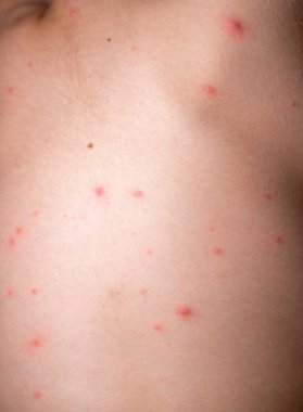 Çocuk kırmızı sivilceler ve suçiçeği ya da varisella zoster virüsü yüzünden kabarcık olmuş. Çocuklarda viral hastalık. Vücudunun her yerinde kırmızı sivilceler var. Enfeksiyon.