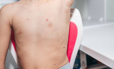 Çocuk kırmızı sivilceler ve suçiçeği ya da varisella zoster virüsü yüzünden kabarcık olmuş. Çocuklarda viral hastalık. Vücudunun her yerinde kırmızı sivilceler var. Enfeksiyon.