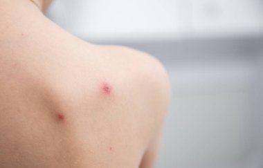 Çocuk kırmızı sivilceler ve suçiçeği ya da varisella zoster virüsü yüzünden kabarcık olmuş. Çocuklarda viral hastalık. Vücudunun her yerinde kırmızı sivilceler var. Enfeksiyon.