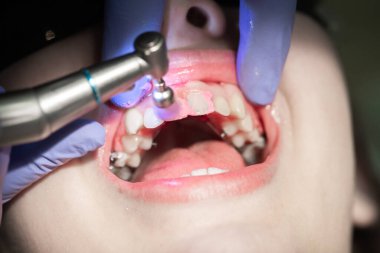 Dişçide dişlerini fırçalamak, dişlerini diş telleriyle fırçalamak..