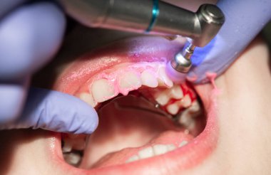 Dişçide dişlerini fırçalamak, dişlerini diş telleriyle fırçalamak..