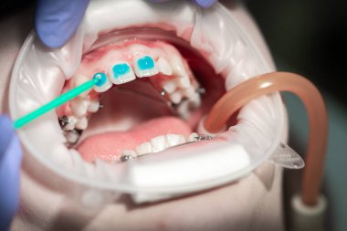 Diş teli takmadan önce dişlere sürtünme, ergenlikte eğri dişler, diş bakımı, dişçi muayenesi -.