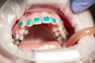 Diş teli takmadan önce dişlere sürtünme, ergenlikte eğri dişler, diş bakımı, dişçi muayenesi -.