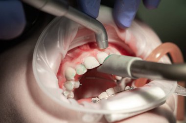 Dişçide dişlerini fırçalamak, dişlerini diş telleriyle fırçalamak..