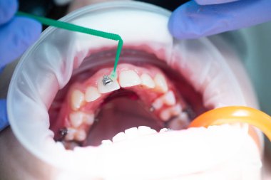 Üst dişlere diş teli takılacak. Bir ortodontist tarafından tedavi. Diş tellerine odaklan. Seçici Keskinlik.