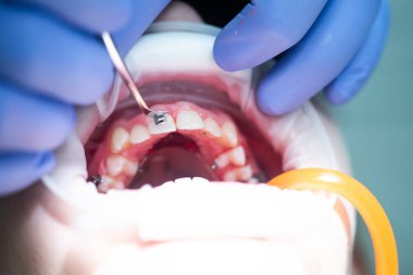 Üst dişlere diş teli takılacak. Bir ortodontist tarafından tedavi. Diş tellerine odaklan. Seçici Keskinlik.