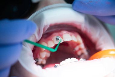 Üst dişlere diş teli takılacak. Bir ortodontist tarafından tedavi. Diş tellerine odaklan. Seçici Keskinlik.