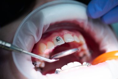 Üst dişlere diş teli takılacak. Bir ortodontist tarafından tedavi. Diş tellerine odaklan. Seçici Keskinlik.