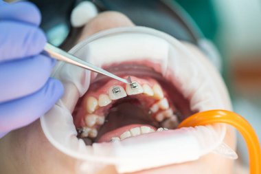 Üst dişlere diş teli takılacak. Bir ortodontist tarafından tedavi. Diş tellerine odaklan. Seçici Keskinlik.