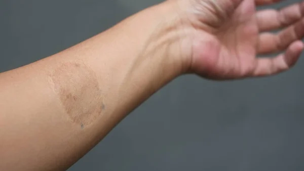 a male arm that has a suture scar. scars the process of removing tattoos by replacing them with skin from other parts of the body