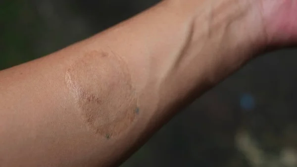 a male arm that has a suture scar. scars the process of removing tattoos by replacing them with skin from other parts of the body