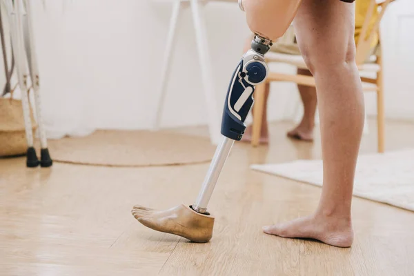 Closeup Αναπηρία Άτομα Πόδι Χρησιμοποιώντας Σύγχρονη Τεχνολογία Προσθετικής Βιονικό Πόδι — Φωτογραφία Αρχείου