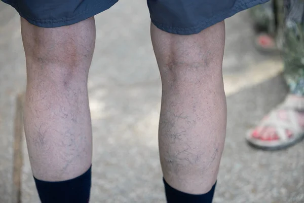 Varicose veins on mens legs. Treatment of varicose veins. High quality photo