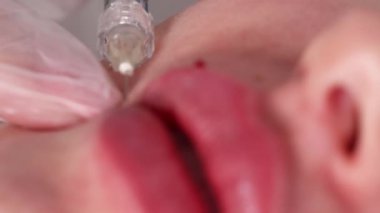  Kozmetik uzmanı, kozmetik güzellik ameliyatı sırasında hastaların dudaklarına iğne enjekte eder. Yüksek kalite 4k görüntü