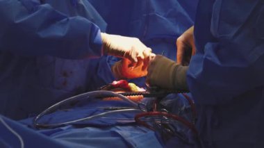 Hastanedeki bir grup cerrah ameliyathanede açık kalp ameliyatı yapıyor. Kalp ameliyatı sırasında açık göğüs cerrahisinde atan bir insan kalbi..
