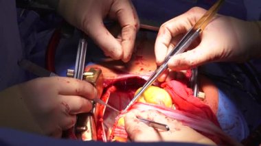 Hastanedeki bir grup cerrah ameliyathanede açık kalp ameliyatı yapıyor. Kalp ameliyatı sırasında açık göğüs cerrahisinde atan bir insan kalbi..