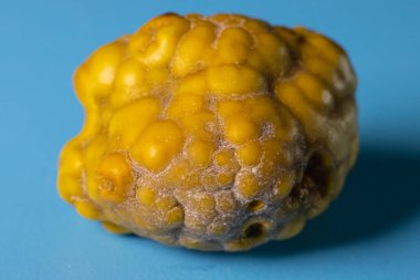 Safra taşı, safra kesesinde kolesterol taşı ve kolesistit. Safra kesesi hastalığı, taş oluşumu. Kolesistektomi Laparoskopik safra kesesi ameliyatına karşı safra taşı alınması.