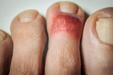 Ayak parmağında hematom var. Derinin altında kanama var. Kırık ayak parmağı