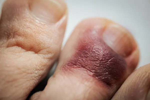 Ayak parmağında hematom var. Derinin altında kanama var. Kırık ayak parmağı