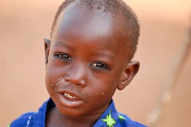 Yüzü lekeli Afrikalı bir çocuk.
