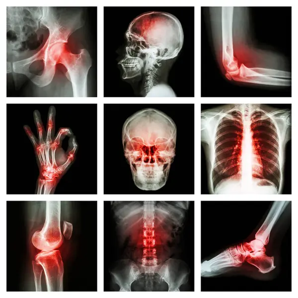 Collection Ray Multiple Injury — Stock Photo, Image