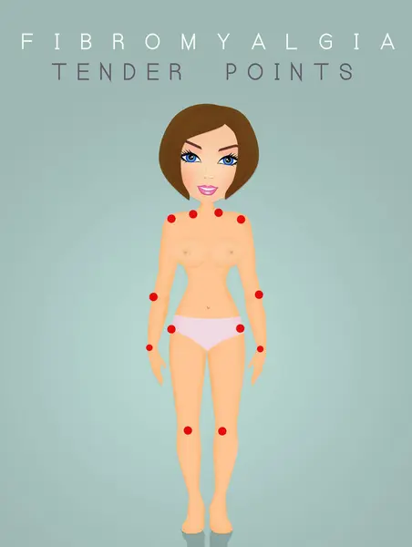 Tender Points Fibromyalgia Woman — Stock Photo, Image