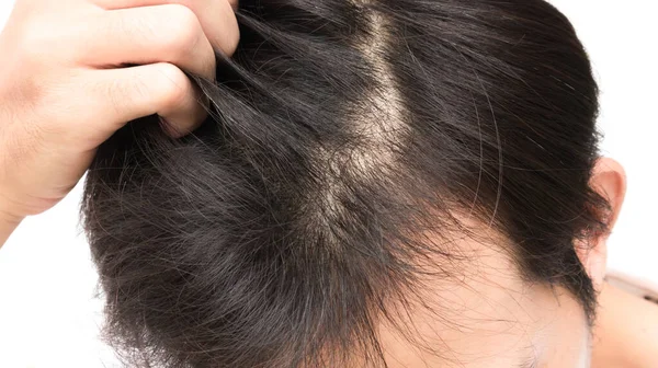 Junger Mann Ernstes Haarausfall Problem Für Das Gesundheitswesen Shampoo Und — Stockfoto