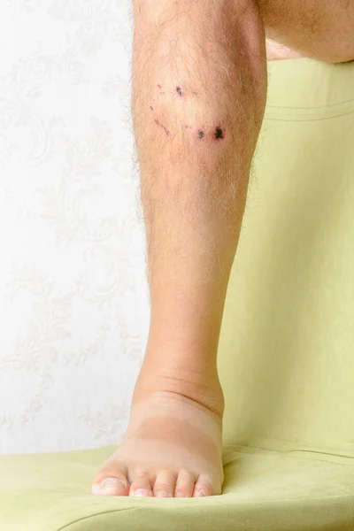 Traces Dog Bites Leg — Stock Photo, Image