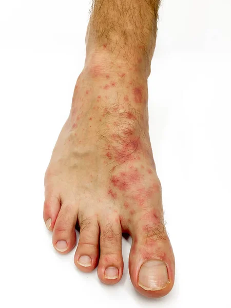 关闭男性的脚和脚趾与红疹忧郁症隔离 — 图库照片